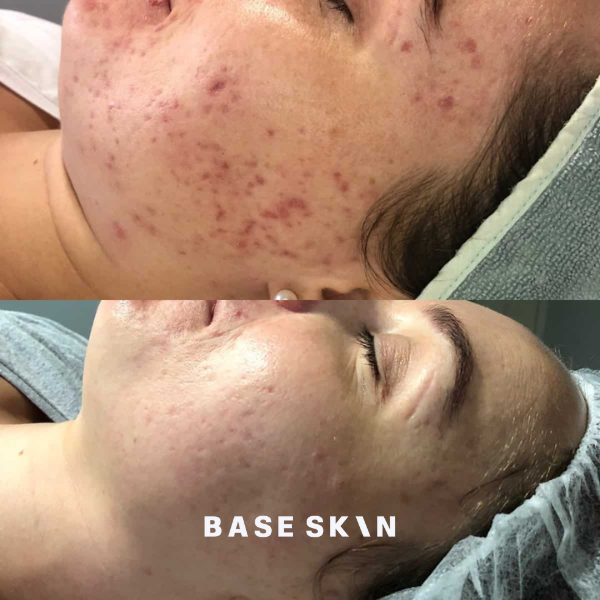 acne and scarring after base skin