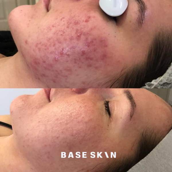 acne redness before and after base skin galway