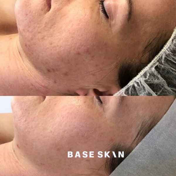 base skin before after skin revision